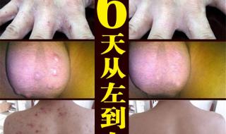 治疗疥疮最好的药膏